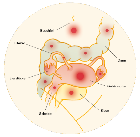 endometriose